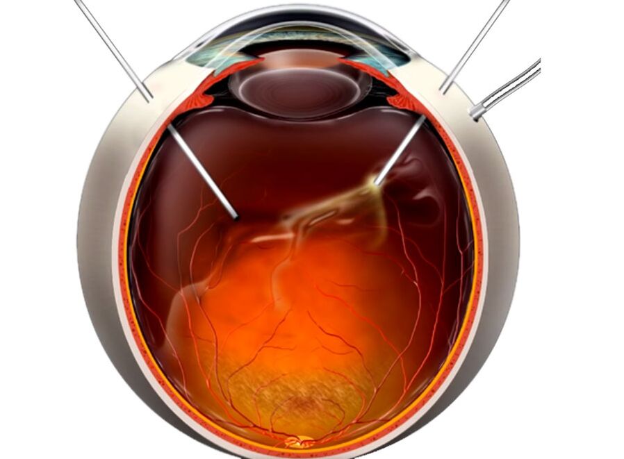 Vitrectomia - Una procedura mostrata alle persone durante l'esfoliazione della retina